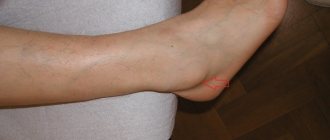 Hygroma