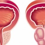 Гиперплазия предстательной железы что за болезнь