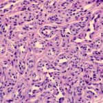 Гистопатология пролиферативной инфантильной гемантиомы