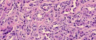 Histopathology of proliferative infantile hemantiomas