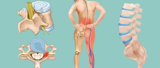 Herniated disc of the lumbar spine