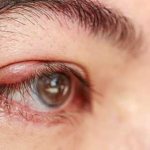 Chalazion photo