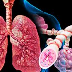 ХОБЛ (хроническая обструктивная болезнь легких)