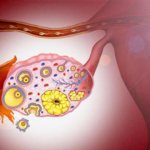 chronic adnexitis treatment at home