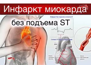 Повреждение миокарда без подъема st. Острый инфаркт миокарда без подъема St. ОИМ без подъема St. ЭКГ инфаркт миокарда без подъема St. Инфаркт без подъема сегмента.