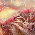 Инфекционный миокардит