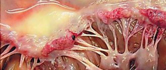 Infectious myocarditis
