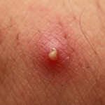 Как лечить фурункул