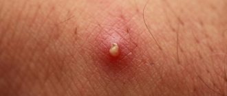 How to treat a boil