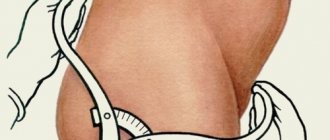 How to determine whether the pelvis is narrow for childbirth