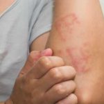 как выглядит экзема