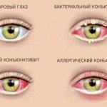 Как вылечивать аллергический конъюнктивит