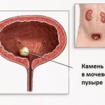 Камень в мочевом пузыре
