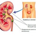 Stones in the kidneys