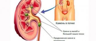 Stones in the kidneys