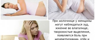 кандидоз у беременной