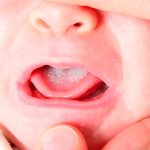 кандидозный стоматит и лечение его дома и в клинике