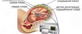 Кардиотокография