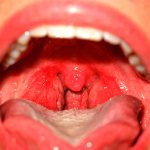 Катаральная ангина