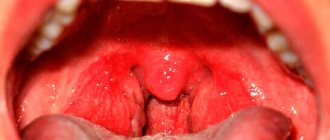 Катаральная ангина