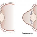 Keratoconus