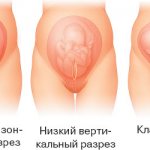 Caesarean section: pros and cons for baby and mother. Indications, consequences, recovery. Advice and opinions from experts 