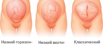 Кесарево сечение: плюсы и минусы для ребенка и мамы. Показания, последствия, восстановление. Советы и мнения специалистов