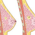 Cyst in the mammary gland