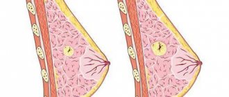 Cyst in the mammary gland