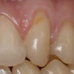 клиновидный дефект