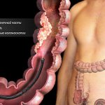 колоноскопия кишечника подготовка