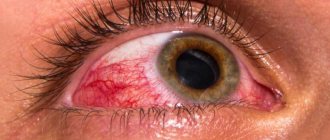 conjunctivitis during pregnancy