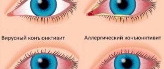 Конъюнктивит у взрослого: аллергический, вирусный, гнойный, хронический. Как передается, симптомы. Лечение, чем промывать глаза. Препараты, народные средства