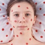 Measles during pregnancy