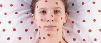 Measles during pregnancy