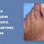 косточка на большом пальце ноги