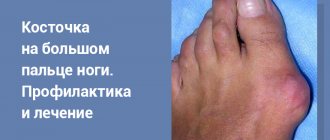 big toe bunion