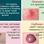 Красные родинки на теле у мужчин и женщин. Что это значит, причины и лечение