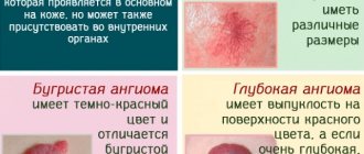 Red moles on the body in men and women. What does this mean, causes and treatment