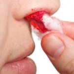 Кровь из носа