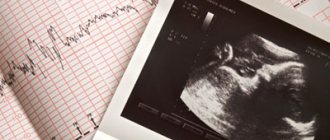 CTG during pregnancy