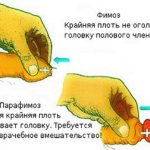 Лечение фимоза у мальчиков и мужчин