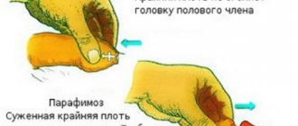 Лечение фимоза у мальчиков и мужчин