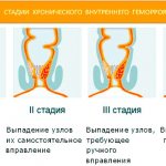 Treatment of hemorrhoids. Exercises, suppositories, folk and pharmacy remedies, diet at home 