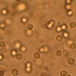 Лейкоциты а моче ребенка