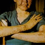 Лепроматозная лепра