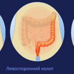 Левосторонний колит: что такое, причины и лечение