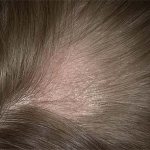 Ringworm on the scalp