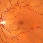 Макула глаза