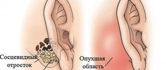 Mastoiditis